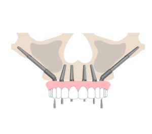 השתלה בזאלית אצל דר פיש - כל מה שצריך לדעת על שתלים בזאליים